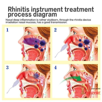 Aparelho - Tratamento Laser para Rinite/Sinusite/Alergia - MagazineInnovar